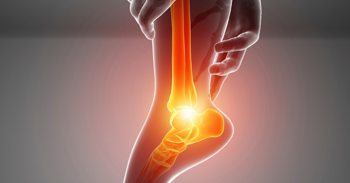 Foot and ankle assessment and physiotherapy for plantar fasciitis